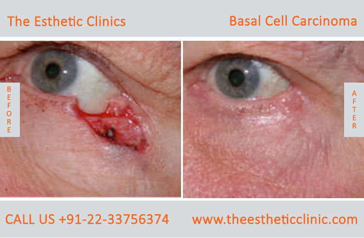 Basal Cell Carcinoma Treatment Surgery before after photos in mumbai india (3)